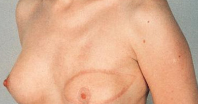 Reconstruccion mamaria: tumerectomia o mastectomia
