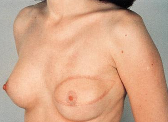 Reconstruccion mamaria: tumerectomia o mastectomia
