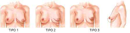 diferenciación de senos tubulares por tipos